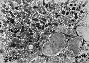 F,3m. | giant cell hepatitis - cholestasis F,3m. | giant cell hepatitis - cholestasis